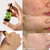 Vibrant Glamour Herbal Acne Treatment Serum 17ml